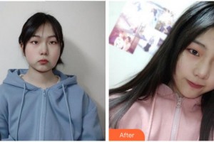 四川華美紫馨醫(yī)學(xué)美容醫(yī)院黃劍美整形價(jià)格表附埋線提升案例展示