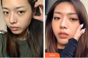 四川華美紫馨醫(yī)學(xué)美容醫(yī)院王小玉整形價(jià)格表附埋線提升案例展示