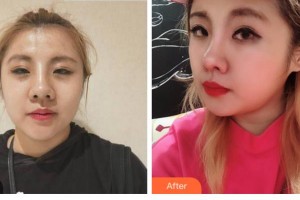 四川華美紫馨醫(yī)學(xué)美容醫(yī)院李純青整形價格表附熱瑪吉案例展示