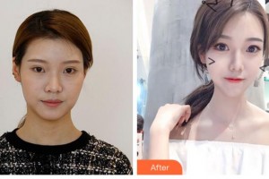 四川華美紫馨醫(yī)學(xué)美容醫(yī)院陳揚(yáng)整形價格表附埋線提升案例展示