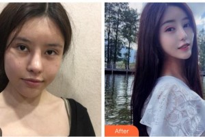 四川華美紫馨醫(yī)學(xué)美容醫(yī)院秦曉整形價格表附熱瑪吉案例展示