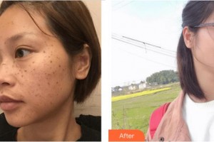 四川西嬋整形美容醫(yī)院顏磊整形價(jià)格表附祛斑案例展示