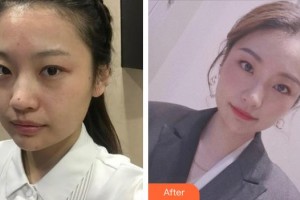 四川西嬋整形美容醫(yī)院李珺整形價格表附激光祛斑案例展示