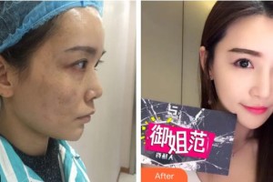 四川西嬋整形美容醫(yī)院曾占權(quán)整形價格表附激光祛斑案例展示