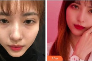 四川華美紫馨醫(yī)學(xué)美容醫(yī)院宋曉東整形價格表附激光祛斑案例展示