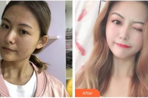 四川華美紫馨醫(yī)學(xué)美容醫(yī)院黃文整形價格表附皮膚管理案例展示