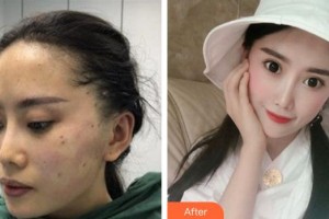 四川西嬋泛亞醫(yī)學(xué)美容醫(yī)院吳亮廷整形價格表附埋線提升案例展示