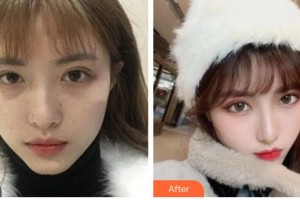 四川西嬋泛亞醫(yī)學(xué)美容醫(yī)院馮中和整形價格表附熱瑪吉案例展示