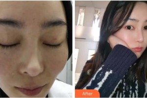 四川西嬋泛亞醫(yī)學(xué)美容醫(yī)院丁艷整形價格表附激光祛斑案例展示