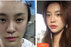 四川西嬋泛亞醫(yī)學(xué)美容醫(yī)院賴穎整形價(jià)格表附埋線提升案例展示