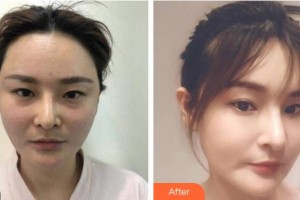 四川西嬋泛亞醫(yī)學(xué)美容醫(yī)院程林整形價(jià)格表附埋線提升案例展示