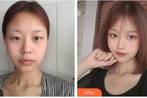 自貢市第四人民醫(yī)院整形美容科鐘富彬住院醫(yī)師整形價(jià)格表附光子嫩膚案例展示