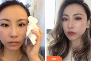 攀枝花大華醫(yī)學(xué)美容醫(yī)院劉永洪整形價(jià)格表附埋線提升案例展示