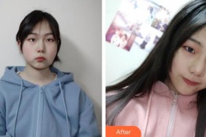 攀枝花市中心醫(yī)院燒傷整形美容科汪濤整形價(jià)格表附埋線提升案例展示