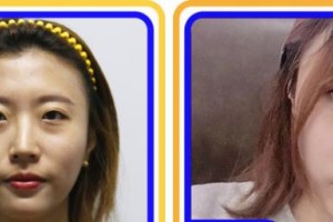 攀枝花愛爾眼科醫(yī)院江蓉整形價(jià)格表附眼部綜合案例展示