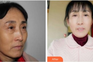 瀘州碧特牙科醫(yī)院屈晶整形價(jià)格表附外切祛眼袋案例展示