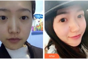 瀘州醫(yī)學(xué)院附屬醫(yī)院整形燒傷科廖毅 教授整形價(jià)格表附切開雙眼皮案例展示