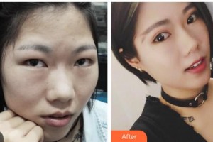 瀘州醫(yī)學(xué)院附屬醫(yī)院整形燒傷科熊愛兵整形價(jià)格表附切開雙眼皮案例展示