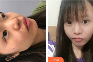 瀘州醫(yī)學(xué)院附屬醫(yī)院整形燒傷科郭力整形價(jià)格表附手術(shù)祛疤案例展示