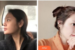 瀘州陳清整形美容醫(yī)院陳清整形價(jià)格表附假體隆鼻案例展示