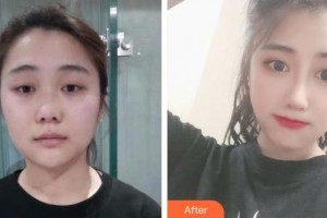 瀘州醫(yī)學(xué)院附屬醫(yī)院整形燒傷科李越鋼整形價(jià)格表附肋軟骨隆鼻案例展示