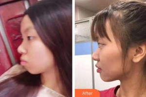 瀘州碧特牙科醫(yī)院陳戎整形價(jià)格表附金屬托槽矯正案例展示