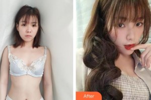 瀘州碧特牙科醫(yī)院孫寶東整形價(jià)格表附自體脂肪隆胸案例展示