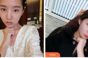 瀘州愛瑞眼科醫(yī)院梅芳整形價(jià)格表附切開雙眼皮案例展示