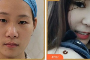 瀘州愛瑞眼科醫(yī)院胡海燕整形價(jià)格表附眼部綜合案例展示