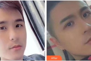 瀘州愛瑞眼科醫(yī)院張可杰整形價(jià)格表附眼部綜合案例展示