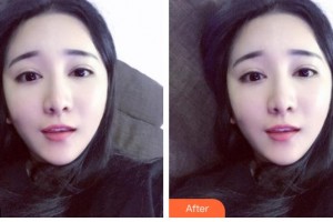 瀘州市婦幼保健院眼科羅光輝整形價(jià)格表附上眼瞼去脂案例展示