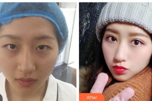 瀘州愛爾眼科醫(yī)院袁長明整形價(jià)格表附眼部綜合案例展示