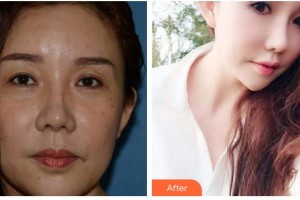 瀘州愛爾眼科醫(yī)院胡明江整形價(jià)格表附外切祛眼袋案例展示