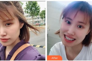 瀘州碧特牙科醫(yī)院周丕立整形價(jià)格表附金屬托槽矯正案例展示