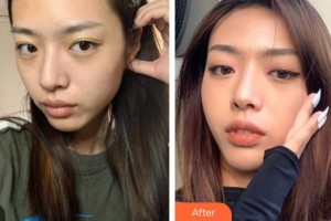 德陽東美醫(yī)療美容整形門診部李黠整形價(jià)格表附埋線提升案例展示