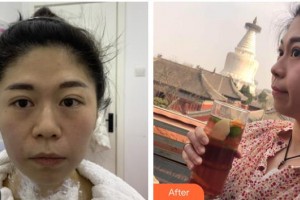 德陽德美醫(yī)療美容門診部莊景菊整形價(jià)格表附熱瑪吉案例展示