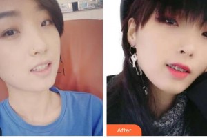 德陽德美醫(yī)療美容門診部蔣克鋒整形價(jià)格表附金屬托槽矯正案例展示