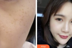 德陽德美醫(yī)療美容門診部張涖整形價(jià)格表附激光美膚激光案例展示