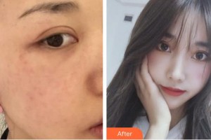 德陽市人民醫(yī)院燒傷整形科李云飛整形價(jià)格表附激光美膚激光案例展示