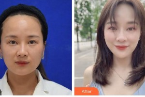 德陽市人民醫(yī)院燒傷整形科胡曉東整形價(jià)格表附埋線提升案例展示