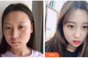 德陽市人民醫(yī)院燒傷整形科李永忠整形價(jià)格表附埋線提升案例展示