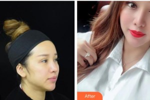 德陽市人民醫(yī)院燒傷整形科陸蓉整形價(jià)格表附射頻緊膚案例展示