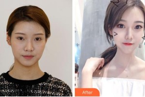 德陽市人民醫(yī)院燒傷整形科陳莉整形價(jià)格表附埋線提升案例展示