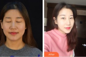 德陽金榮醫(yī)療美容?？漆t(yī)院沈軍國整形價(jià)格表附熱瑪吉案例展示