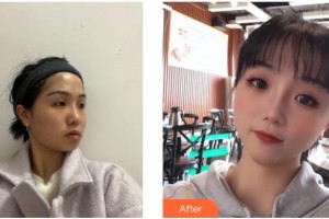 德陽金榮醫(yī)療美容?？漆t(yī)院吳沙冰整形價(jià)格表附埋線提升案例展示