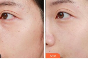 德陽金榮醫(yī)療美容?？漆t(yī)院尹靜整形價(jià)格表附激光美膚激光案例展示