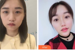 德陽德美醫(yī)療美容門診部王俸祺整形價(jià)格表附熱瑪吉案例展示