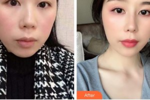 德陽金榮醫(yī)療美容專科醫(yī)院邊森整形價格表附鼻部綜合案例展示