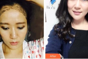 德陽德美醫(yī)療美容門診部于洲戡整形價格表附種植發(fā)際線案例展示