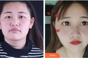 德陽市口腔醫(yī)院整形美容科劉鳳瓊整形價格表附眼部綜合案例展示